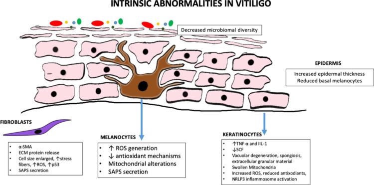 Types of Vitiligo - VitiligoHub