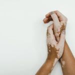 Treatment of vitiligo