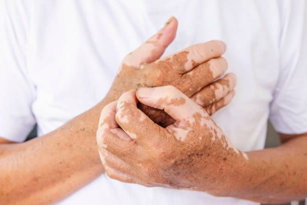 Does vitiligo have a cure?