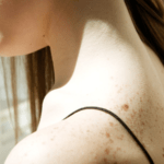 Is Sunlight Good for Vitiligo?